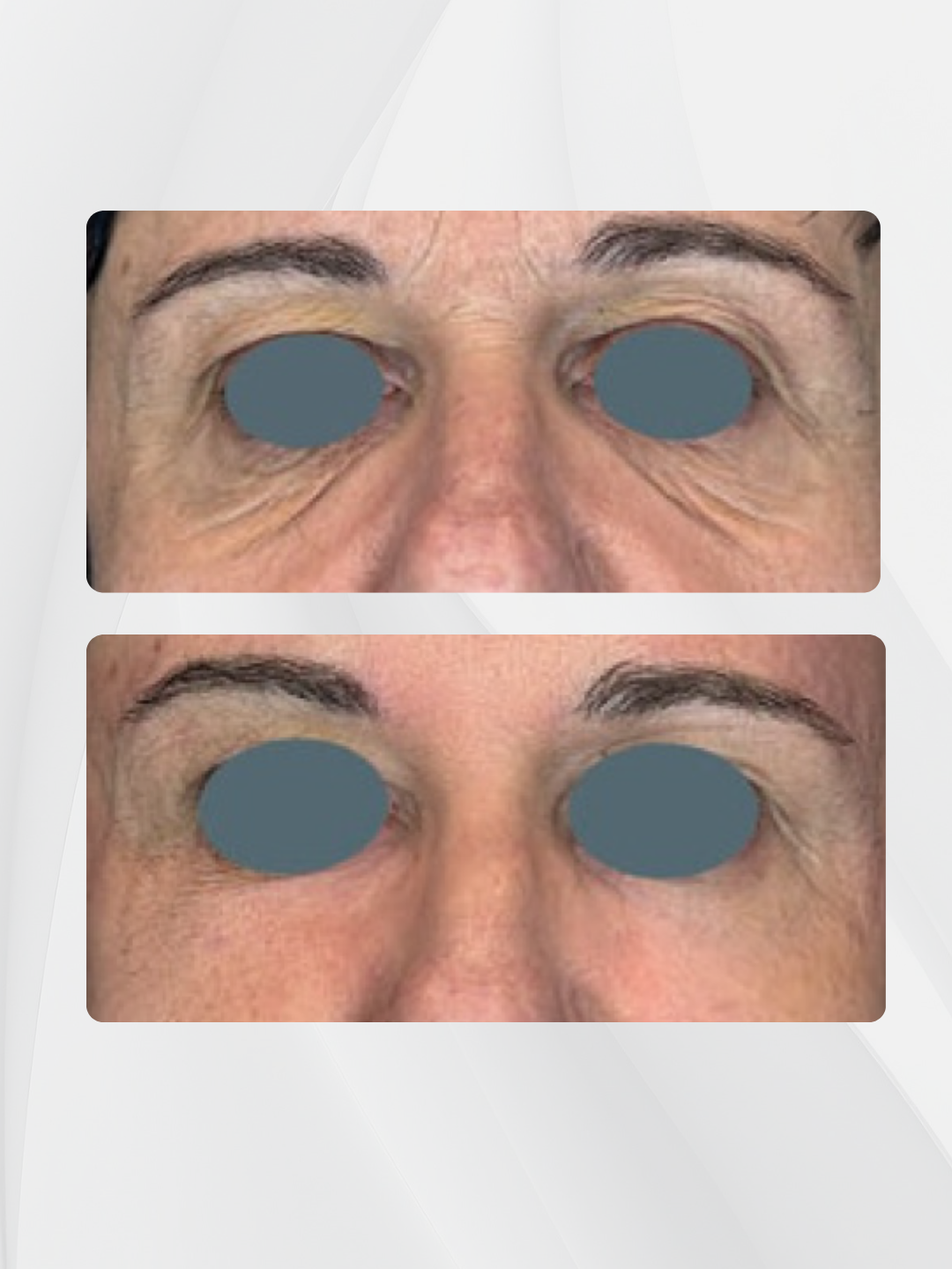 Comparativa antes y después de un tratamiento de rejuvenecimiento facial con Láser CO2 Youlaser Prime, mostrando una mejora visible en arrugas, líneas de expresión y textura de la piel mediante tecnología híbrida CO₂ y fibra 1550 nm.