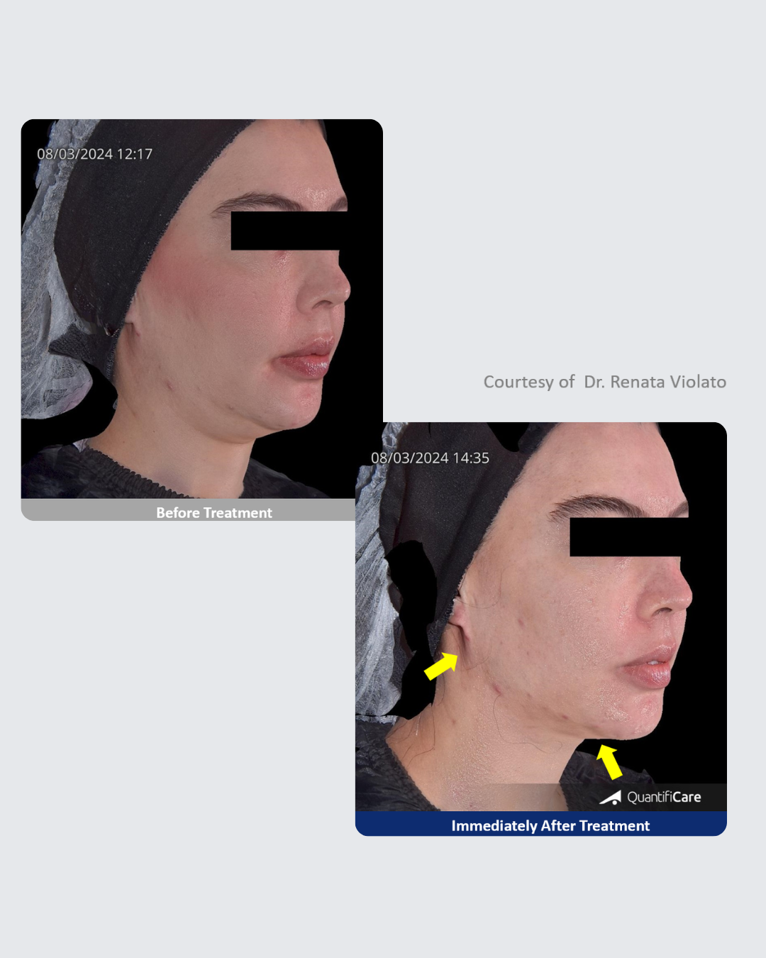 Tratamiento Facial con HIFU Ultraformer MPT EQUIPO