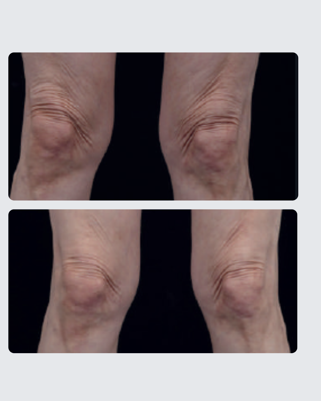 Tratamiento de rodillas con HIFU Ultraformer MPT EQUIPO