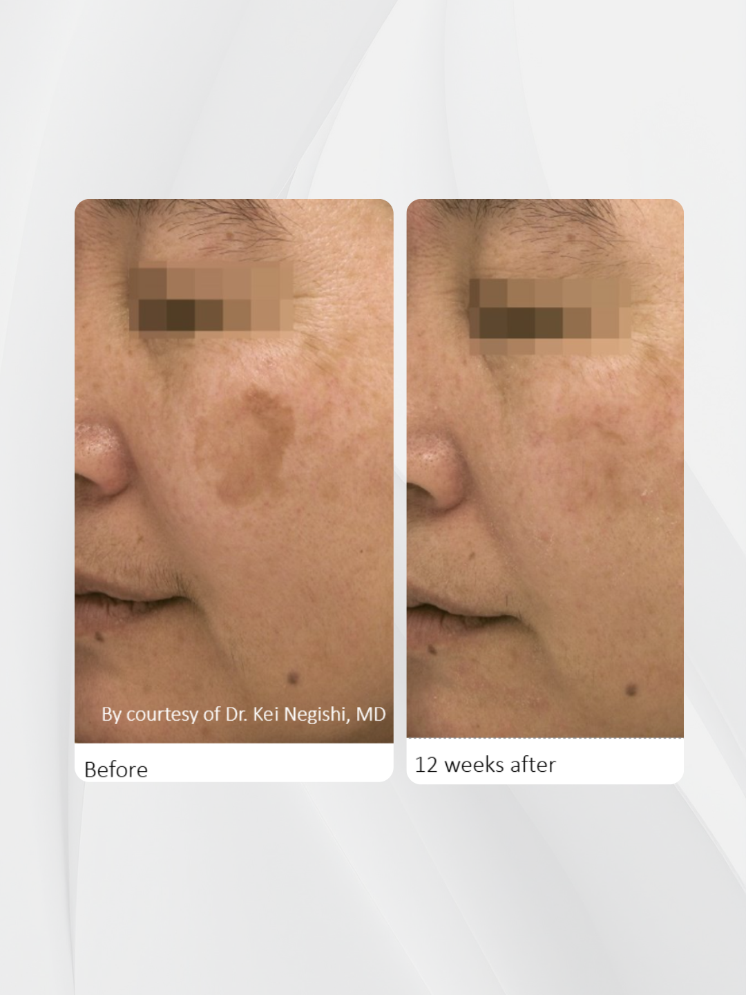 Comparativa antes y después del tratamiento de una lesión pigmentada facial con el Láser Picosegundo Discovery PICO, mostrando una reducción visible del pigmento tras 12 semanas.