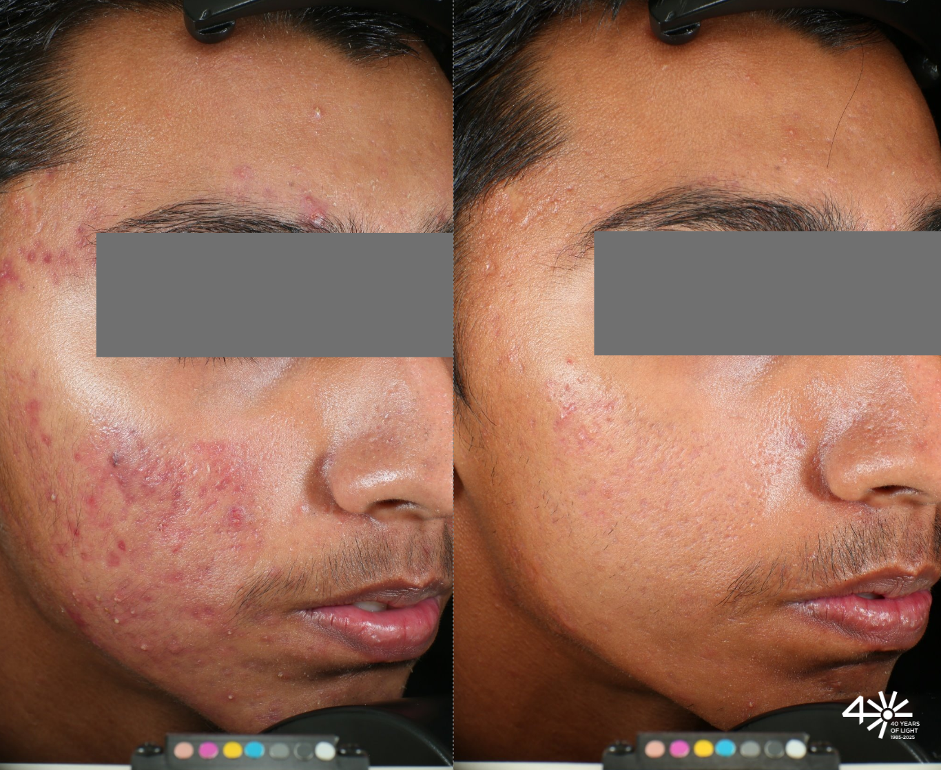 Antes y después del tratamiento de acné en espalda con tecnología láser accure