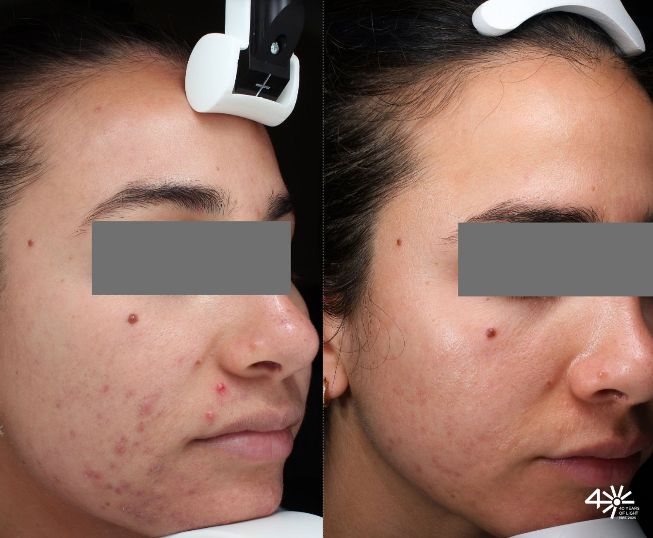 Antes y después del tratamiento de acné en rostro con tecnología láser accure