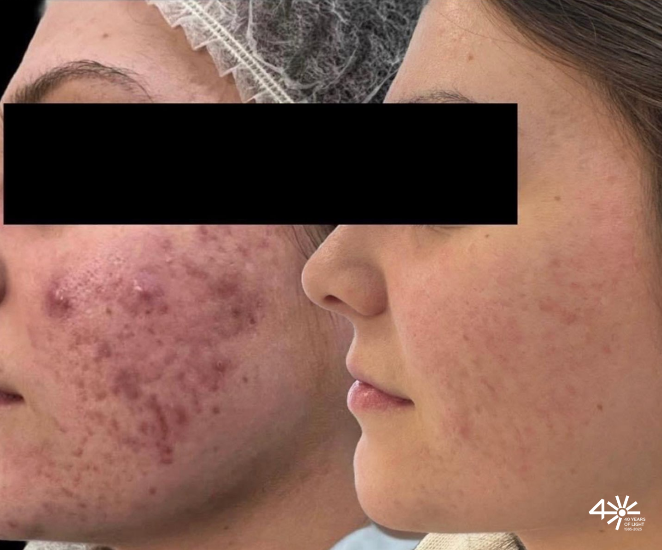 Antes y después del tratamiento del acné con láser Accure de 1726 nm, mostrando reducción de lesiones inflamatorias y mejoría de la piel.