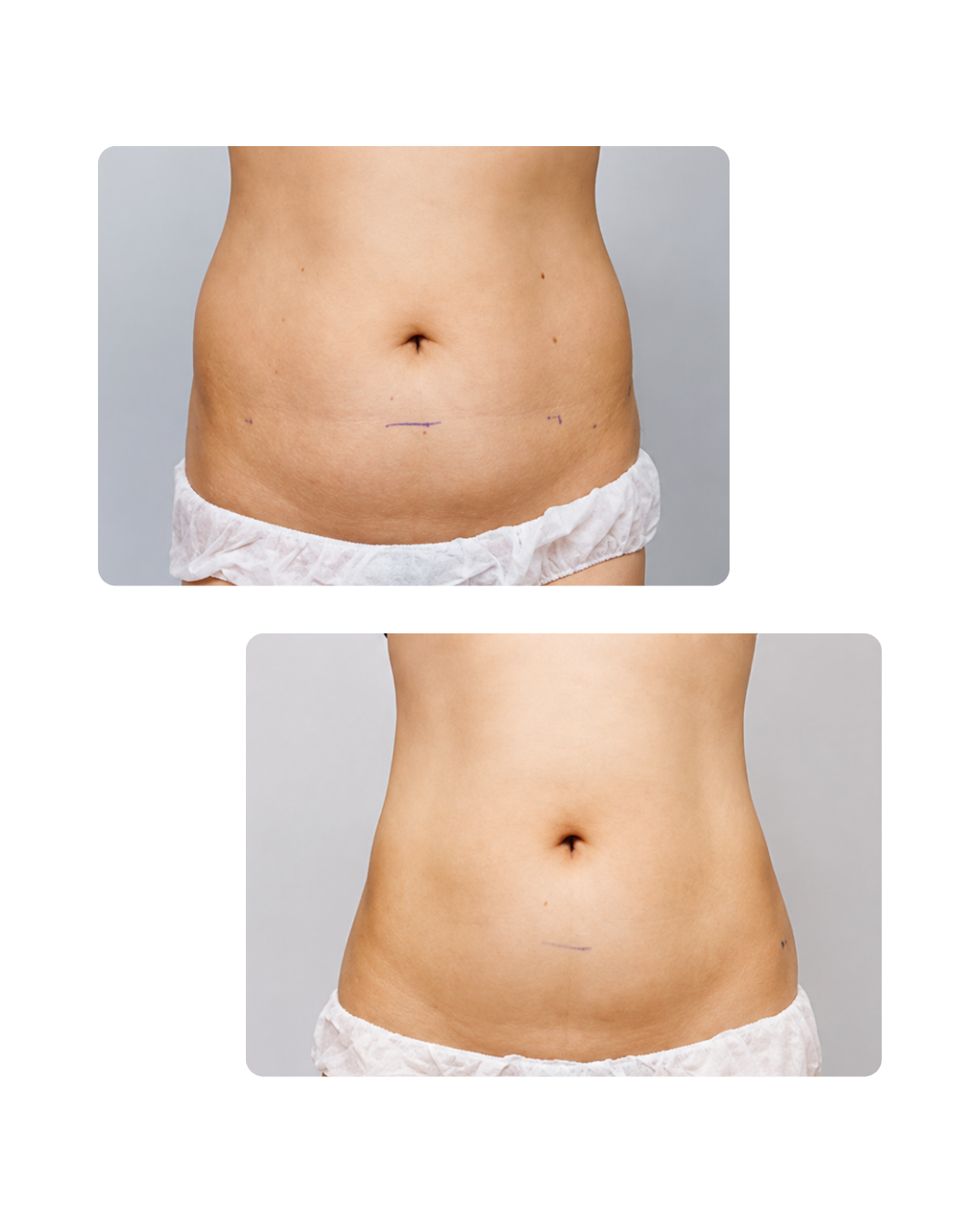 HIFU Tratamiento corporal con HIFU Ultraformer III