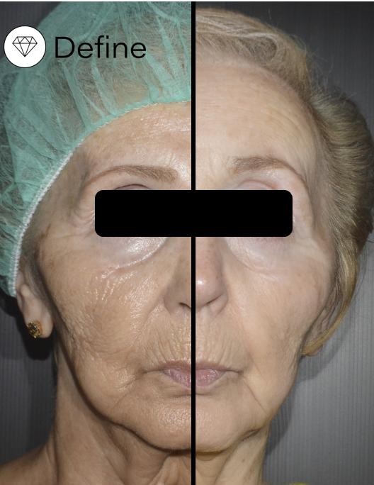Antes y después de tratamiento con láser Chrome de Quanta System para rejuvenecimiento facial y mejora de arrugas.