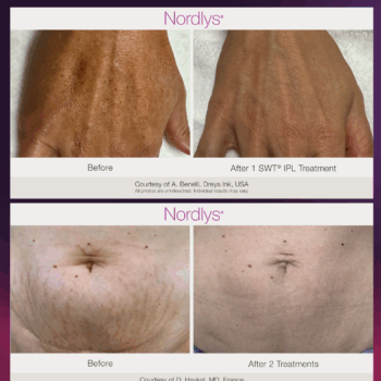 Plataforma Láser e IPL | Nordlys™ - Imagen 4