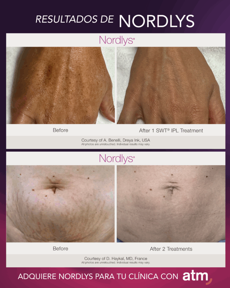 Plataforma Láser e IPL | Nordlys™ - Imagen 4