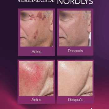 Plataforma Láser e IPL | Nordlys™ - Imagen 5