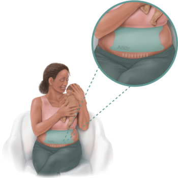 retractor de panículo abdominal para cesárea ABBy