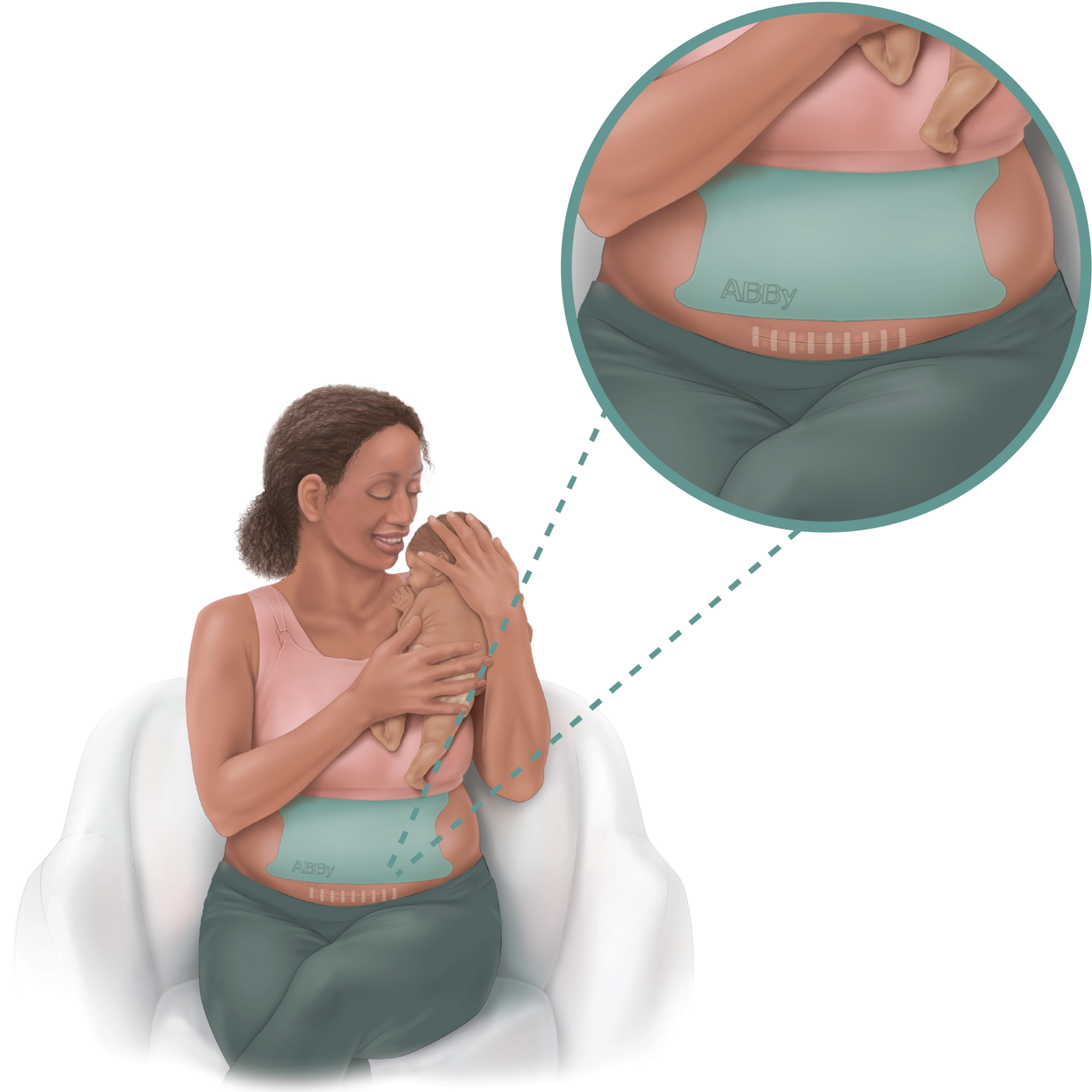 retractor de panículo abdominal para cesárea ABBy