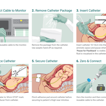 atéter de presión intrauterina KOALA IUPC Laborie
