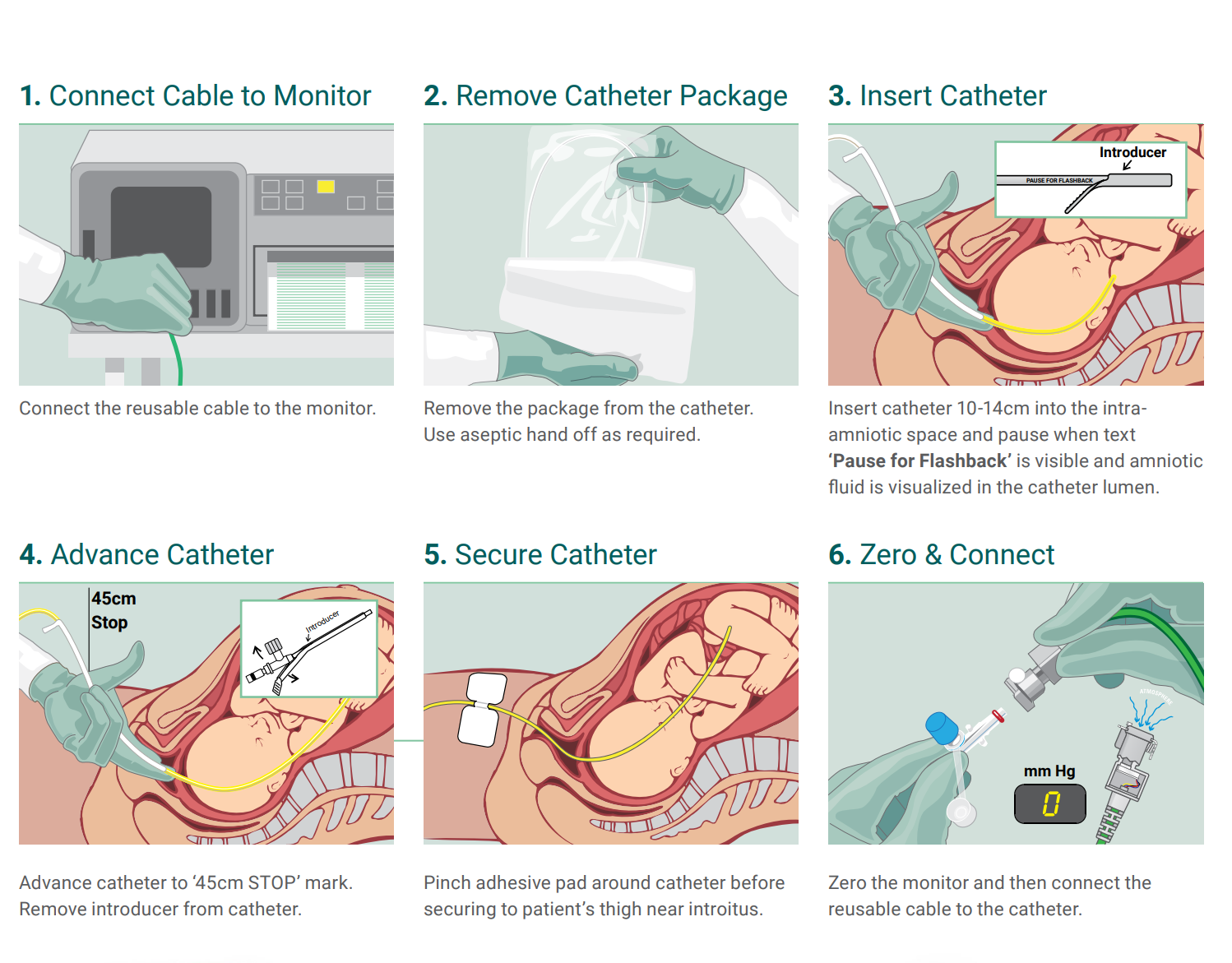 atéter de presión intrauterina KOALA IUPC Laborie