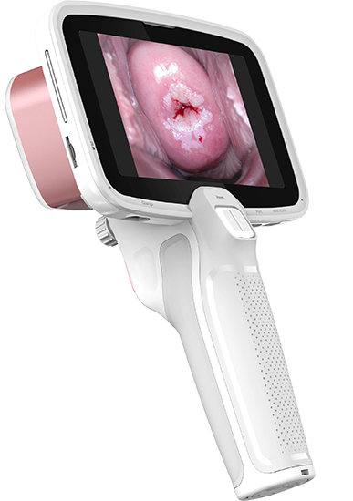 Cámara CerviCARE AI para detección de lesiones cervicouterinas